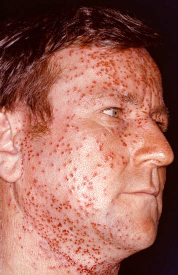 Eczema | Atopic Dermatitis Photos | AAAAI