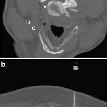 Direct cervical transforaminal nerve root injection. The needle and... | Download Scientific Diagram