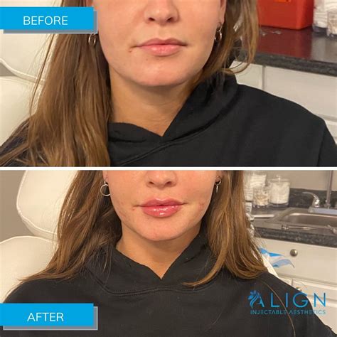 Lip Injections In Tulsa OK Align Injectable Aesthetics