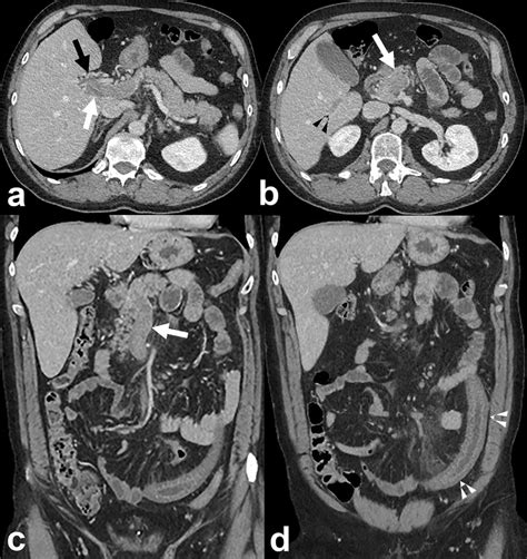 A And B The Contrast Enhanced Mdct Examination Showed Extensive