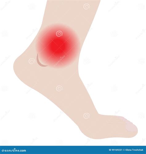 Swelling Of The Feet And Ankles From Infected Or Injury Stock Vector