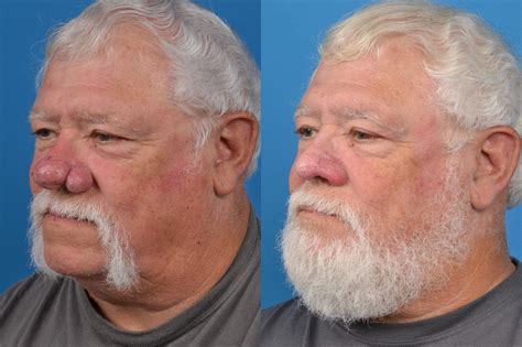 Rhinophyma | Melbourne, FL | Patient 29296