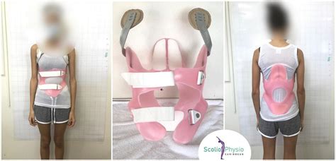 Kyphologic brace – Scolio Physio Caribbean