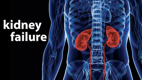 Kidney Failure - Causes, Symptoms, Diet & Treatment