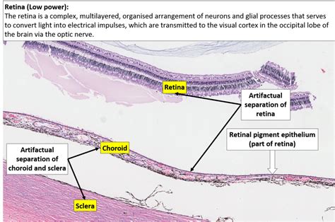 Eye Retina Choroid And Sclera Nus Pathweb Nus Pathweb