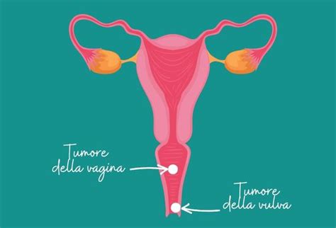 Tumori Rari Focus Su Vagina E Vulva Home Acto Alleanza Contro Il Tumore Ovarico