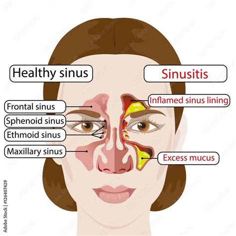 Sinusitis Healthy And Inflamed Sinuses Medical Poster Stock Vector