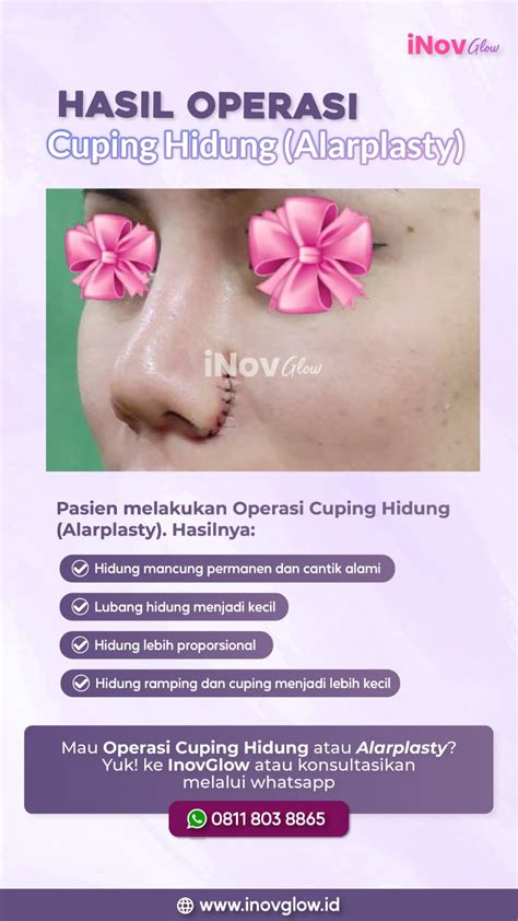 Before After Operasi Hidung Inovglow Klinik Spesialis Bedah Plastik