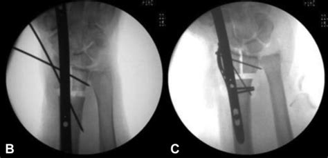 Supplementary Fixation Improves Stability Of Intra Articular Distal