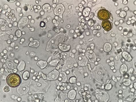 Types Of Cholesterol Crystals In The Urine - What You Should Know!