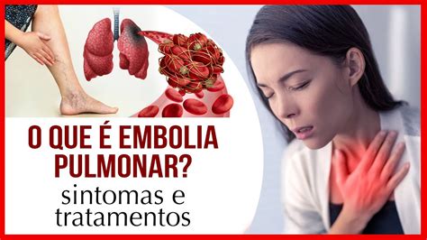 O Que Embolia Pulmonar Veja Causas Sintomas E Tratamentos The Best