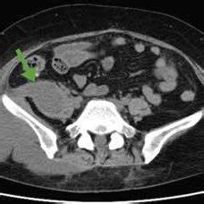 Computed Tomography Horizontal Plane Showed A Low Density Area