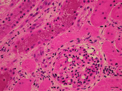 Kidney. Deposits of granular eosinophilic pigment (asterisk), tubular ...