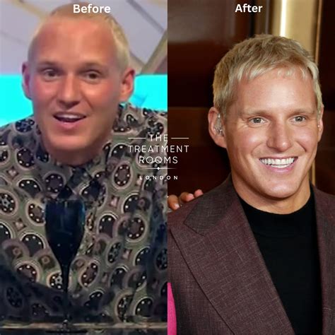 Jamie Laing Hair Transplant: Before, After and His New Hairline