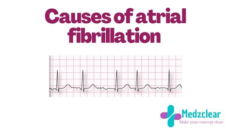 Atrial Fibrillation Causes Easy Way To Remember The Causes Through