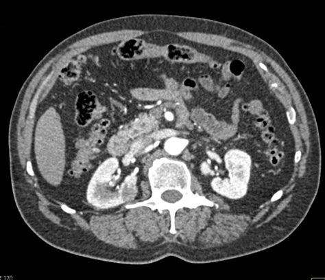 High Density Cyst Upper Pole Left Kidney And Incidental Right Renal