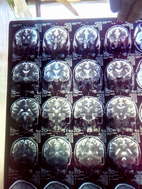 Рассеянный склероз - Вопрос невропатологу - 03 Онлайн