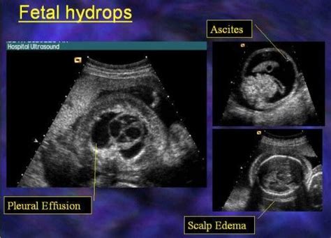 Hydrops Fetalis | fetus | Ultrasound school, Ultrasound sonography ...
