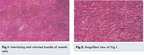 Exophytic Uterine Leiomyoma