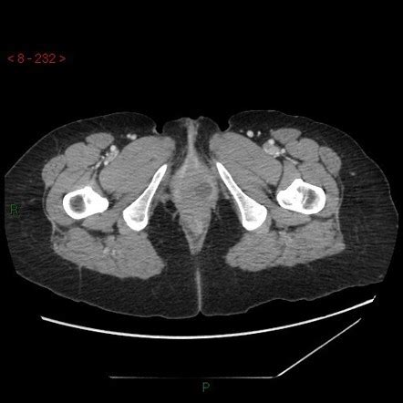 Bartholin Gland Cyst Mri