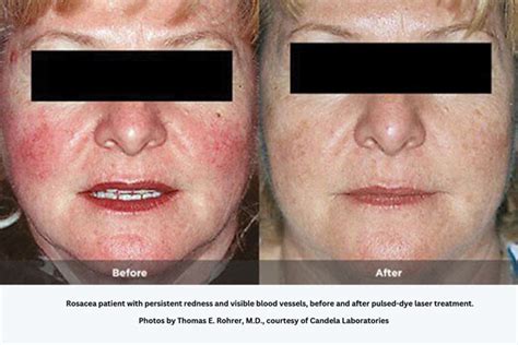 Rosacea Treatments In Bergen County Call Vanity Medical Spa