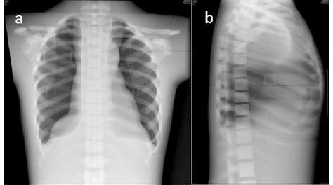 Anterior Posterior A And Lateral B Chest X Ray Views Of The CIRS