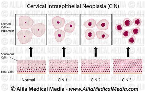 Alila Medical Media Cervical Cancer Stages Medical Illustration