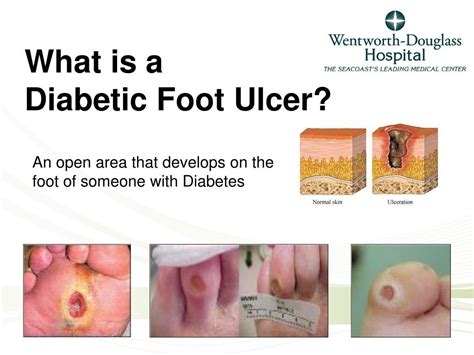 Ppt What Is A Diabetic Foot Ulcer Powerpoint Presentation Free