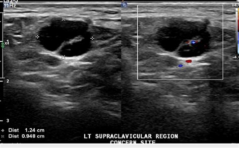 supraclavicular lymphadenopathy ultrasound