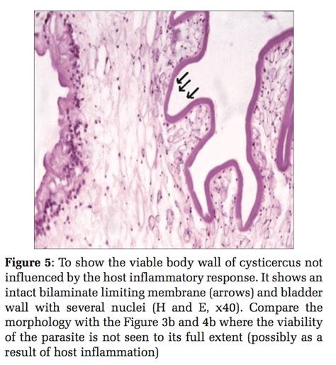 Diagnosis Of Cysticercosis By Fine Needle Aspiration Cytology Report