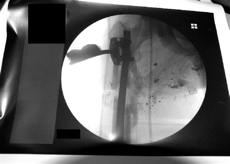 Open Subtrochanteric Femur Fracture Part 2 Now Live Disaster Rx