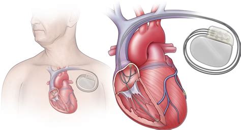 What Is Cardiac Resynchronization Therapy Crt And How Does 54 Off