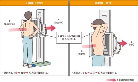 肺がんのレントゲン（x線）検査 肺がんの検査 肺がんとともに生きる