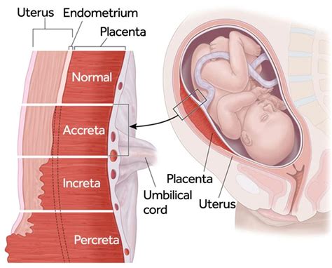 Placenta Previa | Birth Injury Lawyers