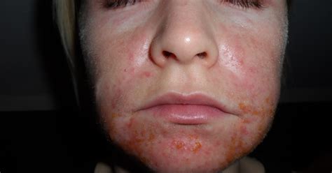 nealkhoerr: Allergie Pickel Im Gesicht