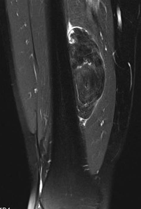 Imaging Features Of Myxoid Soft Tissue Tumours Clinical Radiology