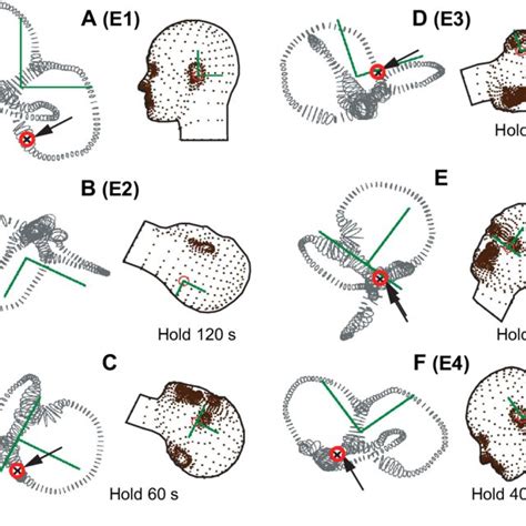 Modified Epley Canalith Repositioning Procedure Sequence Of 6 Head