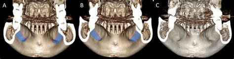 Relationship Of The Mandibular Second Molar Root And Lingual Cortex Of Download Scientific