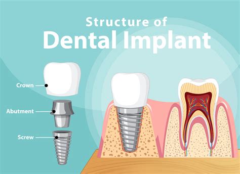 Infographic Of Human In Structure Of The Dental Implant Vector