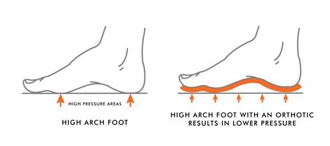how to know if you have high arch