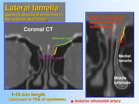 PPT - Anatomy and relevant anatomical variants in nasal and paranasal ...