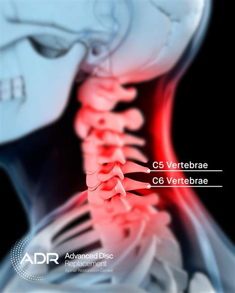 Advanced Disc Replacement | The C5-C6 disc is the spinal disc that most