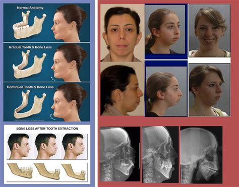 How does "long face syndrome" face ages? : orthodontics