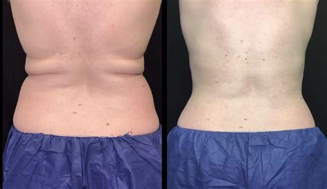 Coolsculpting Denver Coolsculpting Elite Body Contour