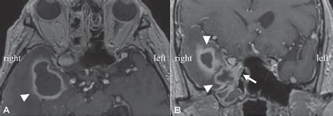 Figure 3 From Invasive Fungal Rhinosinusitis With Orbital Apex Syndrome