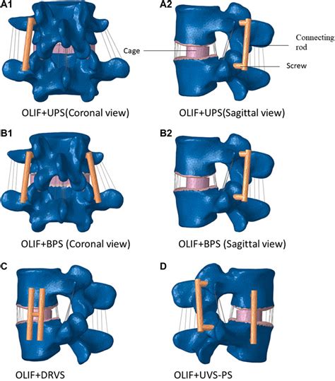 Frontiers Biomechanical Stability Of Oblique Lateral Interbody Fusion