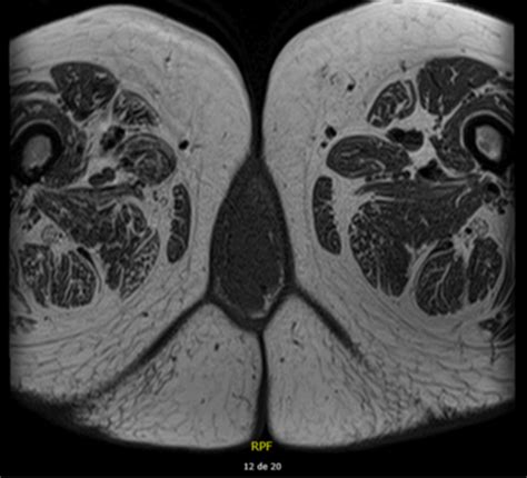 Giant Cellular Angiofibroma Of The Vulva Case Report