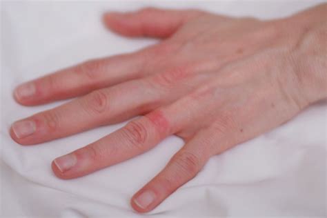 Wedding Ring Rash A Real Life Seven Year Itch Nbc News
