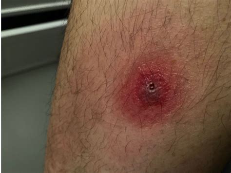 Poisonous Spider Bites