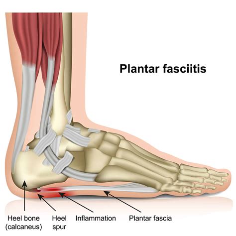 How To Increase Your Va Rating For Plantar Fasciitis